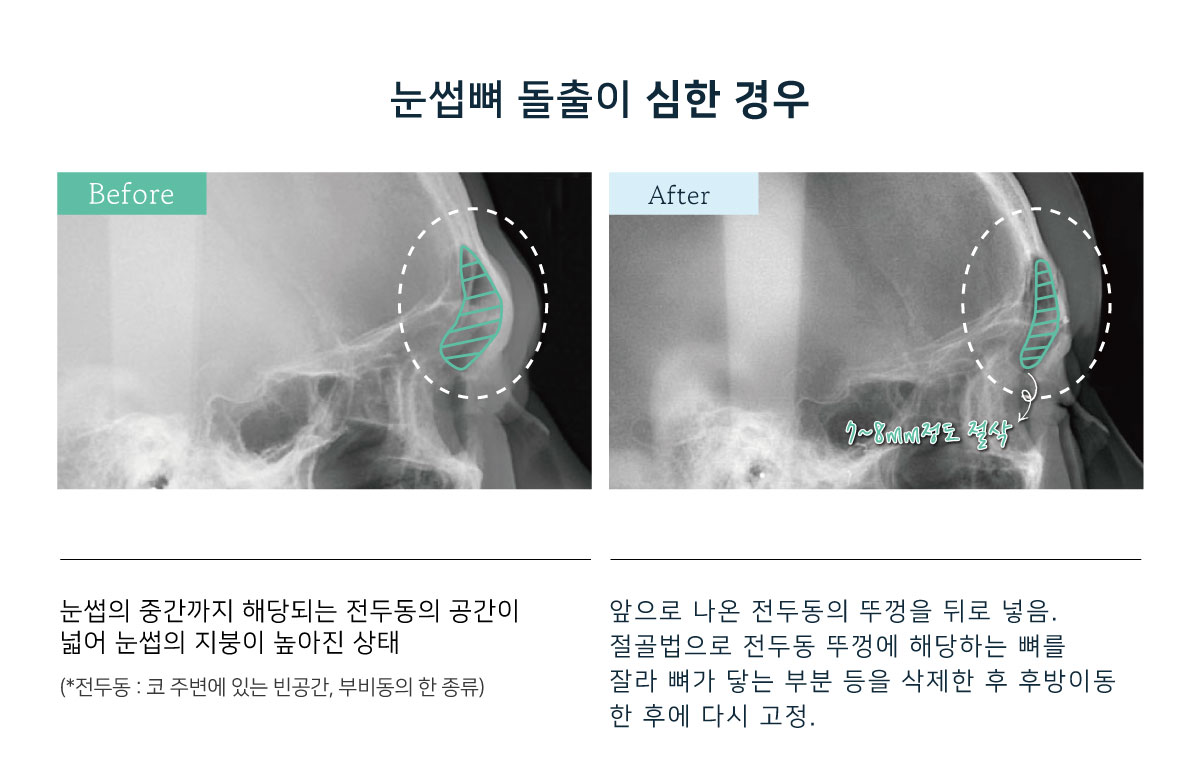 눈썹뼈출소술