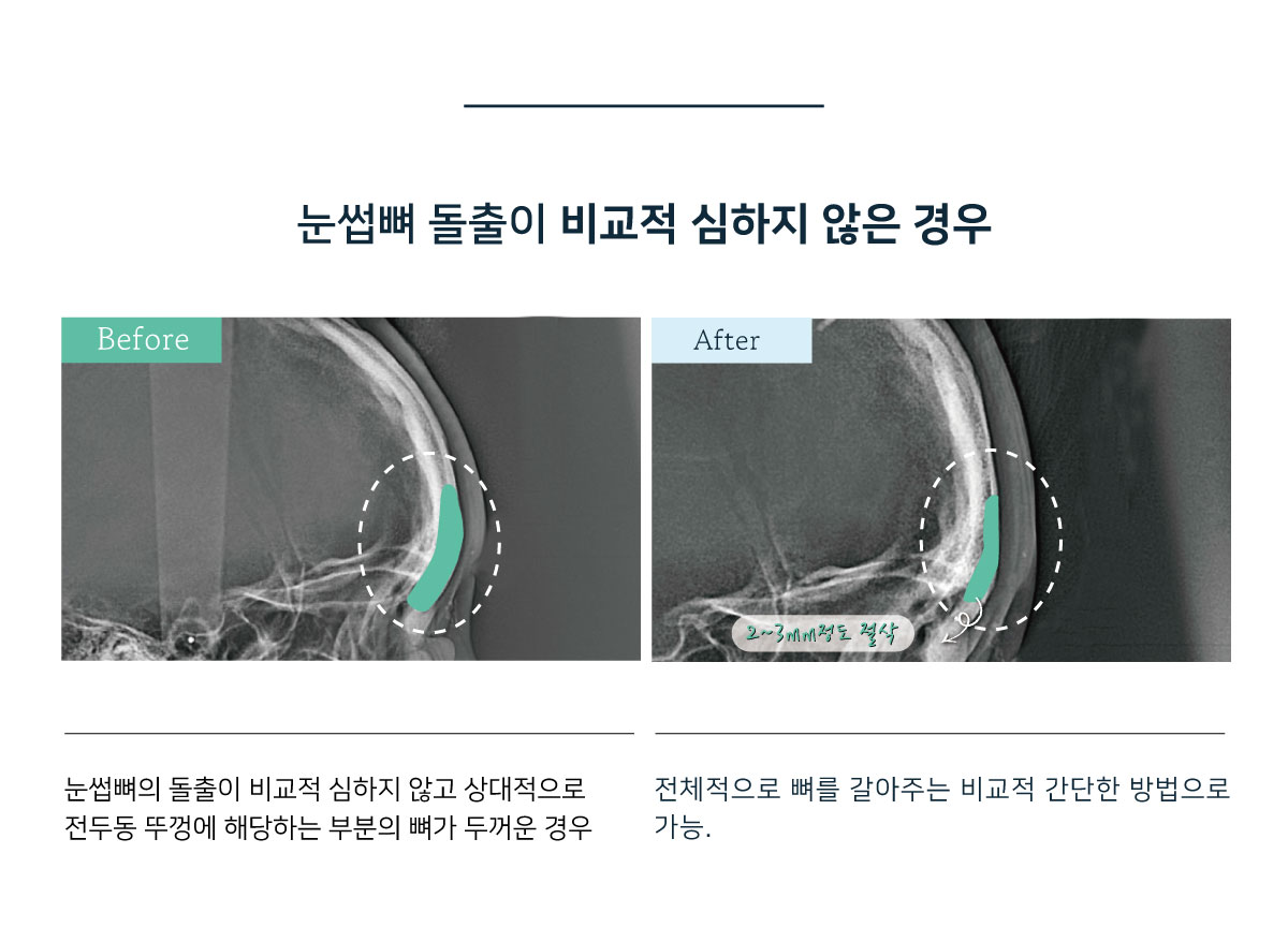 눈썹뼈출소술