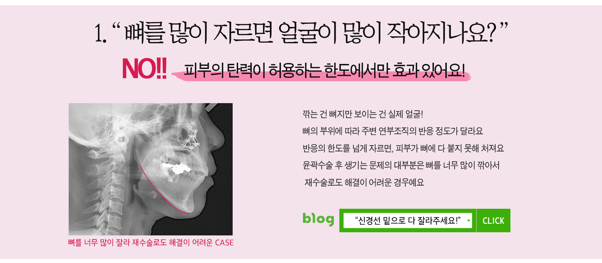 페이스라인 뼈를많이 자르면 얼굴이 많이 작아지나요?