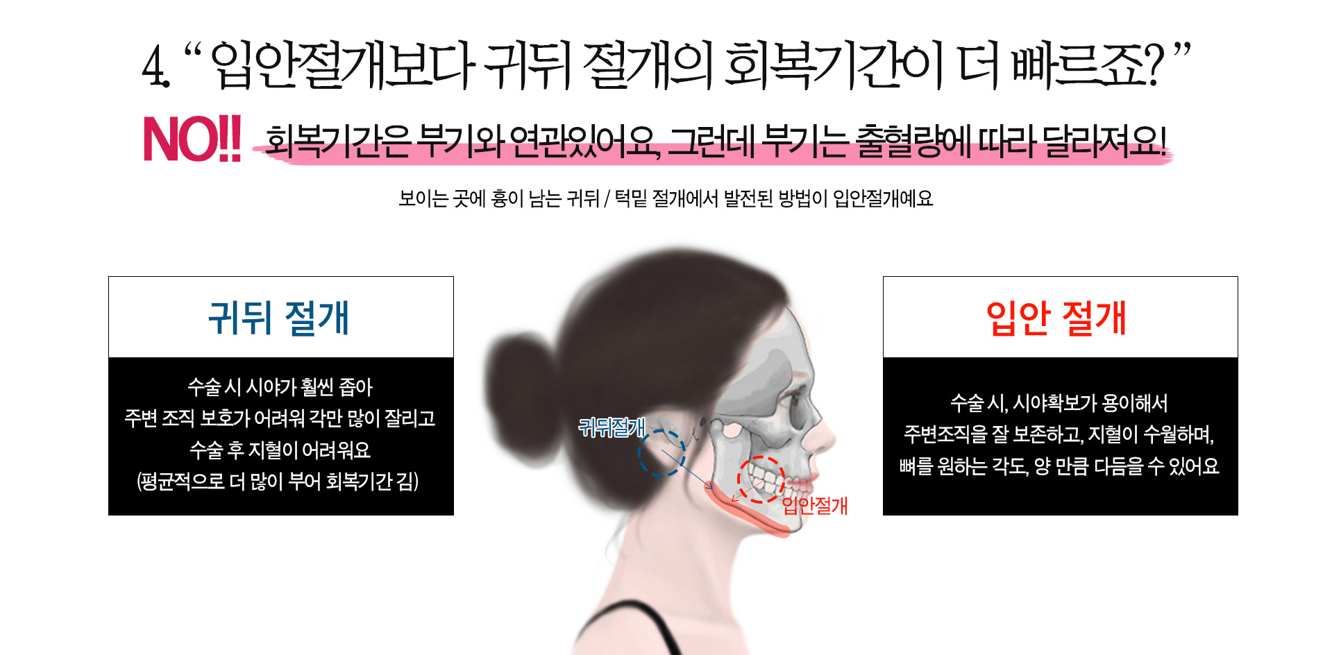 페이스라인 윤곽성형 입안절개보다 귀뒤 절개가 회복기간이 더 빠른 거 아닌가요??