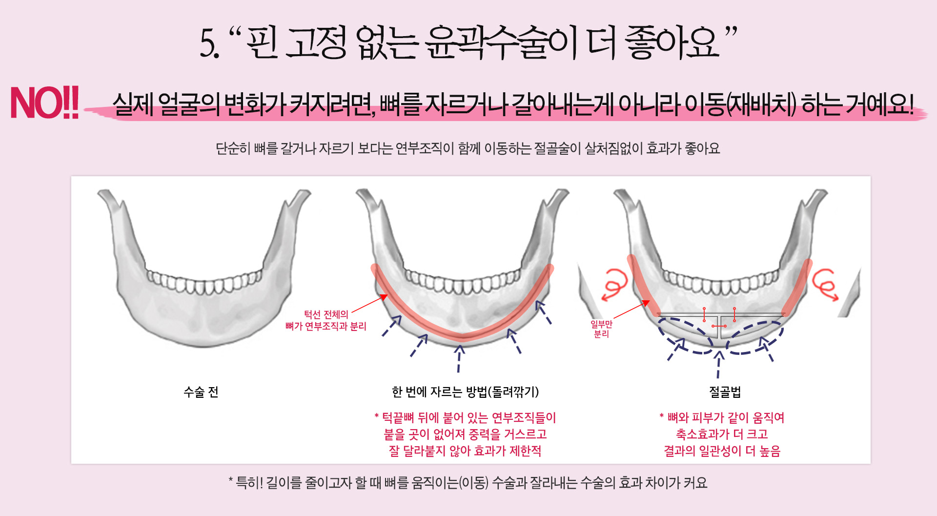 페이스라인 핀 고정 없는 윤곽수술이 더 좋아요