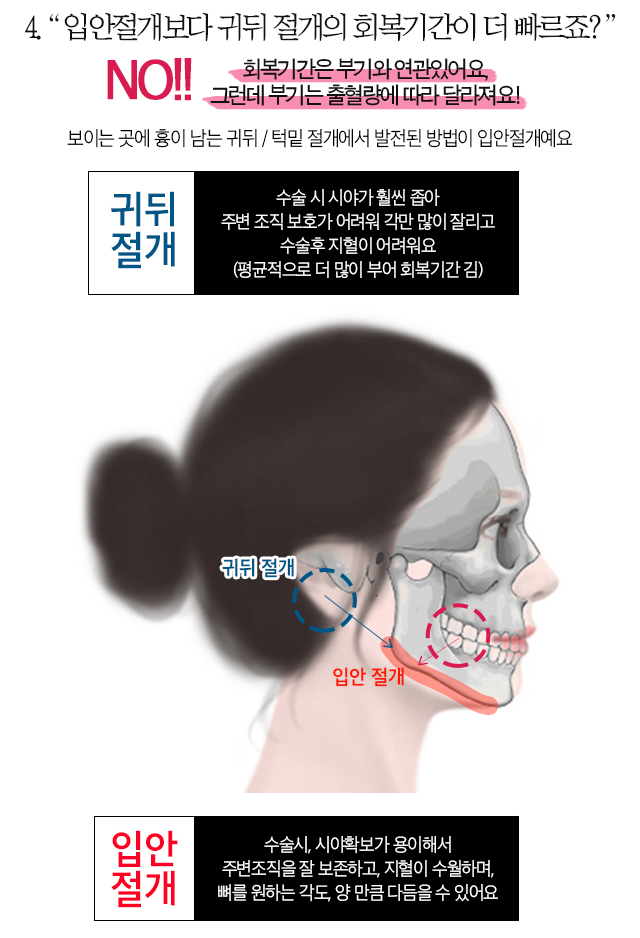 페이스라인 성형외과의원 안면윤곽 오해와 편견 회복기간