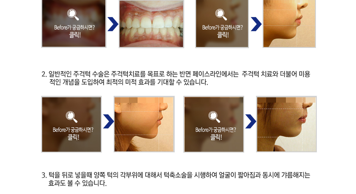 주걱턱.jpg