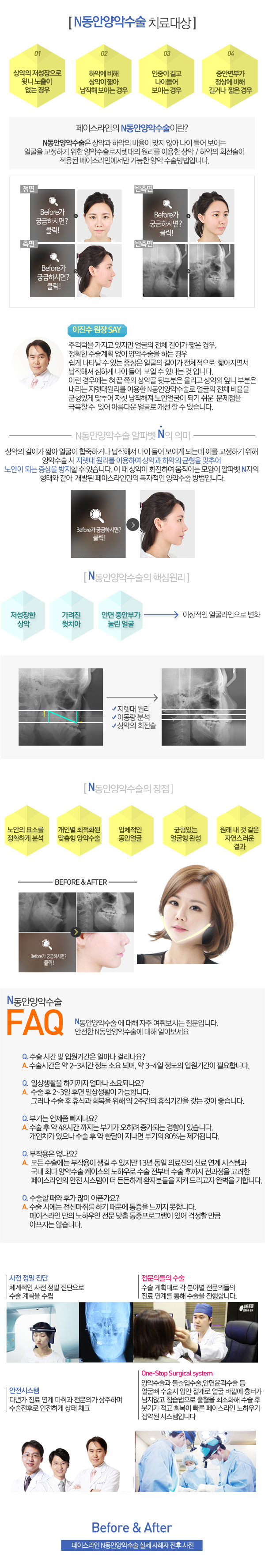 n동안양악수술