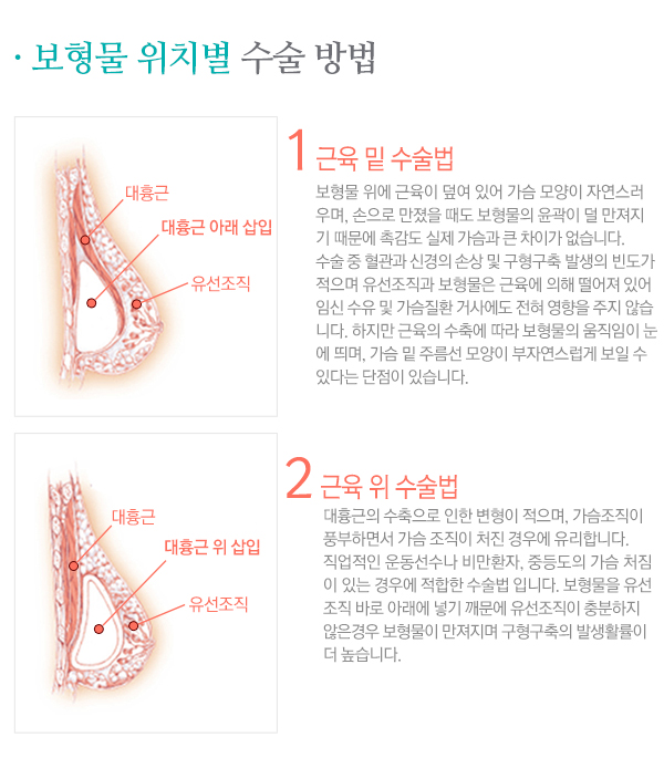 페이스라인 가슴확대술