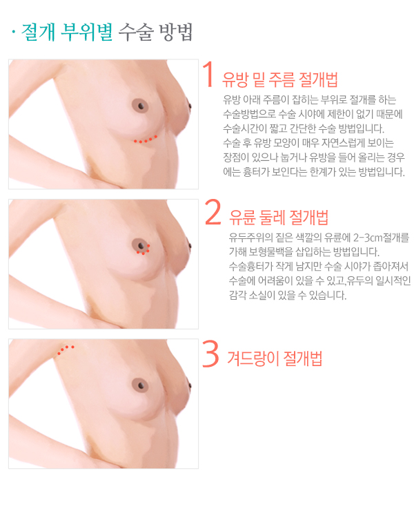 페이스라인 가슴확대술