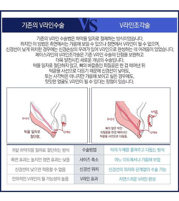 페이스라인 V라인조각술