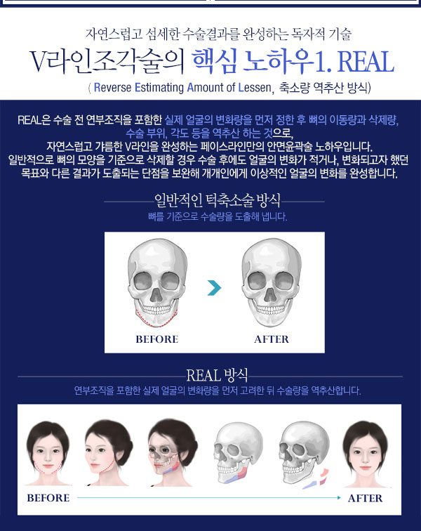 페이스라인 V라인조각술