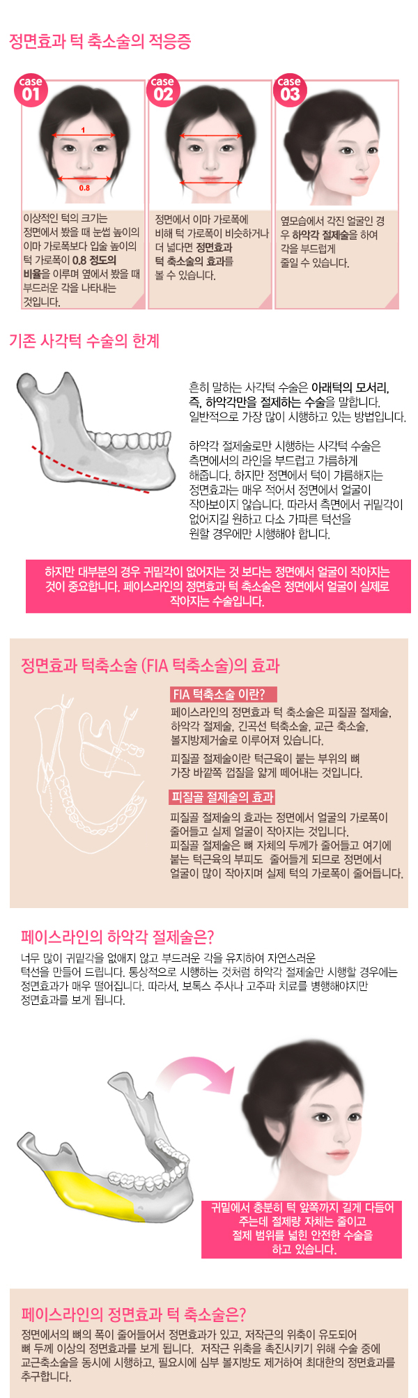페이스라인 사각턱축소술