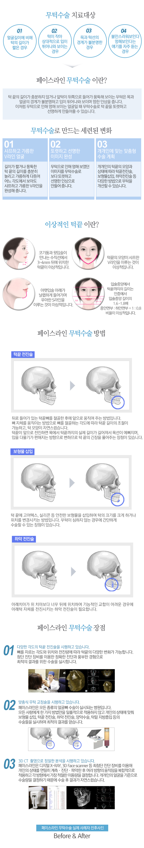 페이스라인 무턱수술