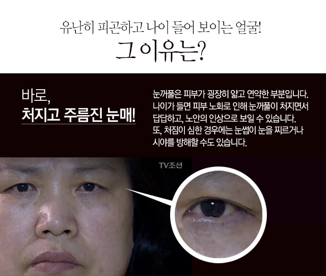 페이스라인 눈썹거상술