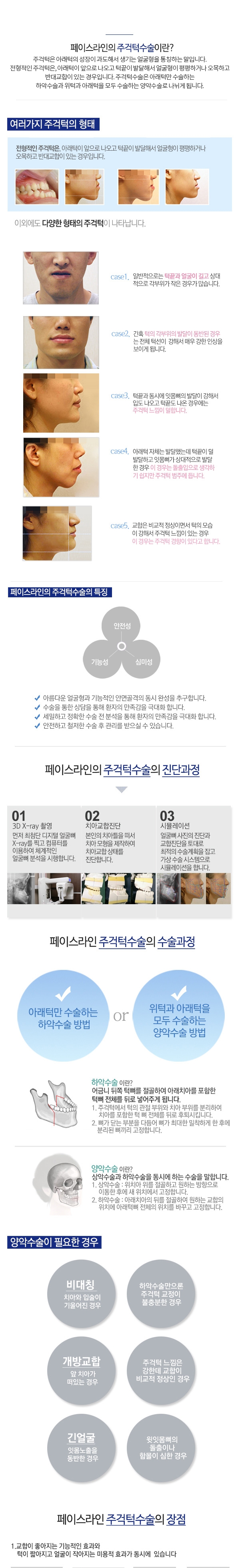 주걱턱(하악수술)