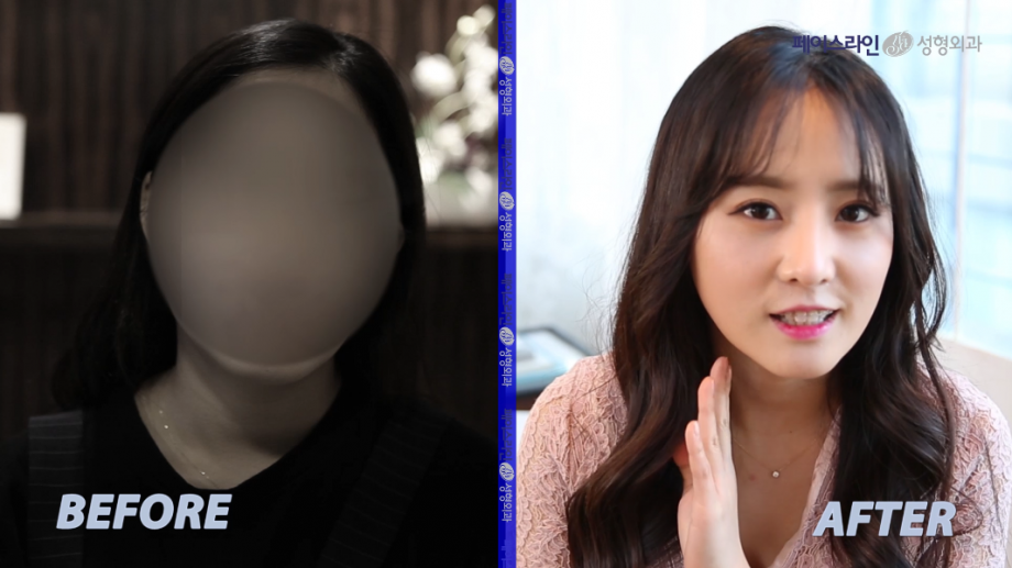 페이스라인-바른성형(윤여주 b&a)