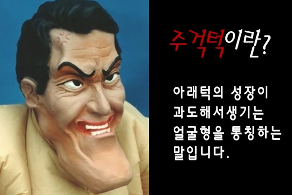 페이스라인주걱턱성형