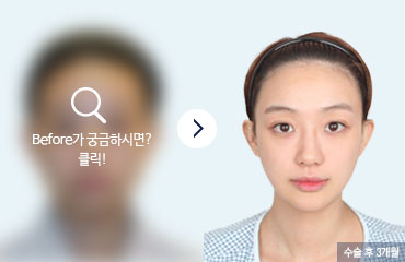 실제 수술 사례자 박소현