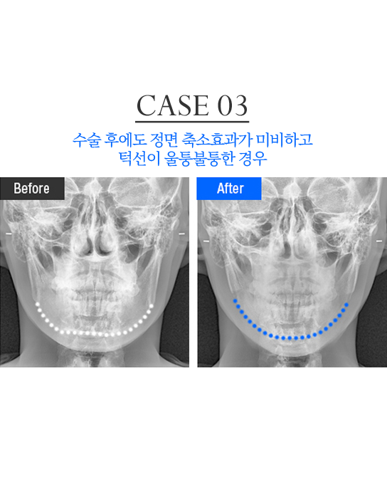 턱 재수술