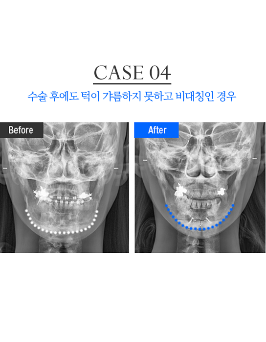 턱 재수술