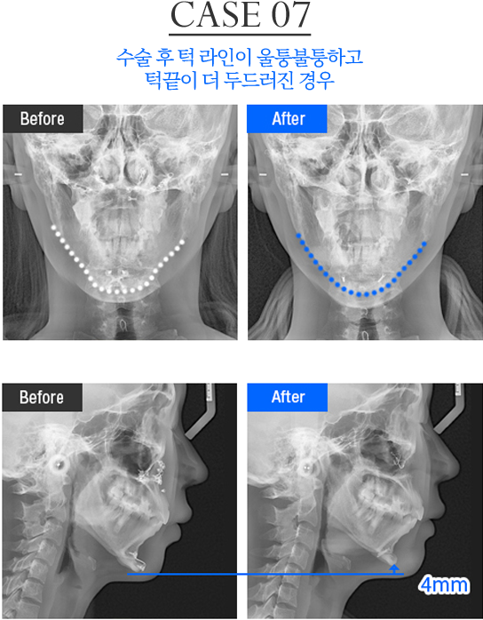 턱 재수술