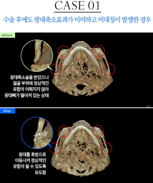 광대 재수술