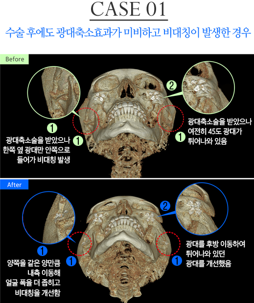 광대 재수술