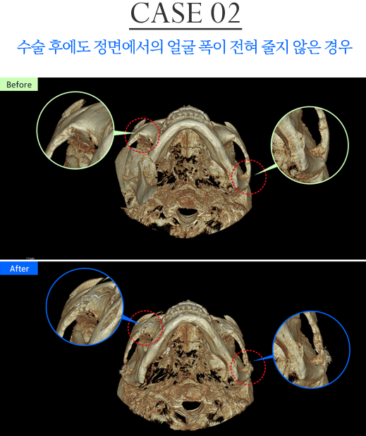 광대 재수술