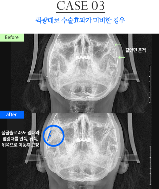 광대 재수술