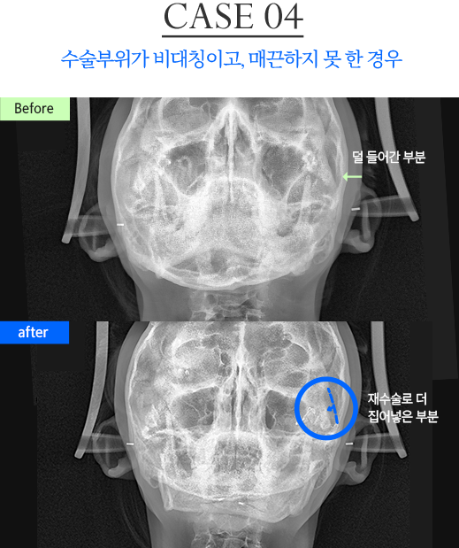 광대 재수술