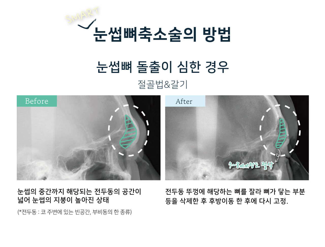 눈썹뼈출소술