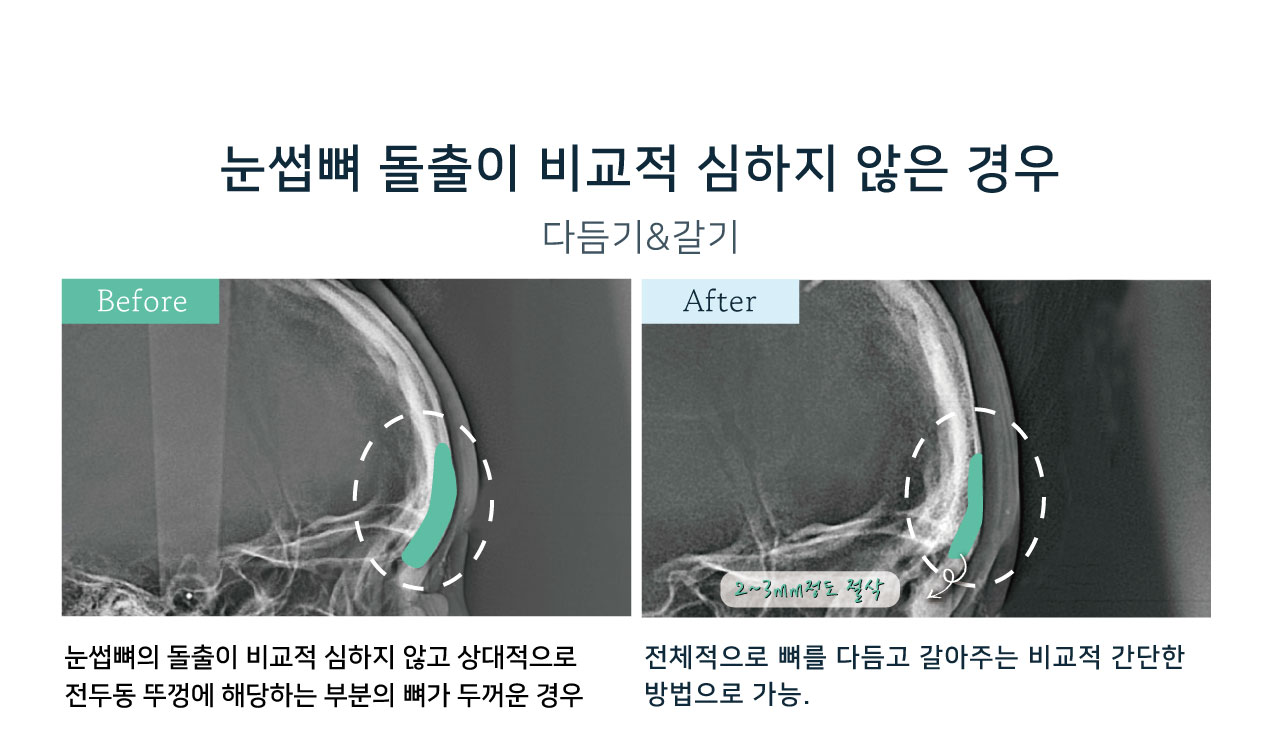 눈썹뼈출소술