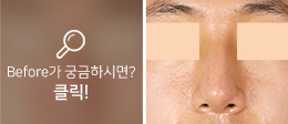 남자눈코성형