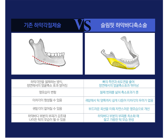 페이스라인 슬림핏하악바디축소술